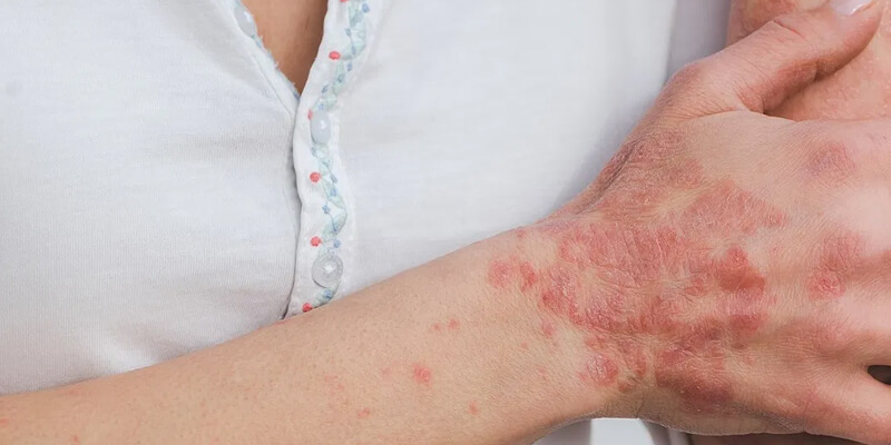 Skin Conditions