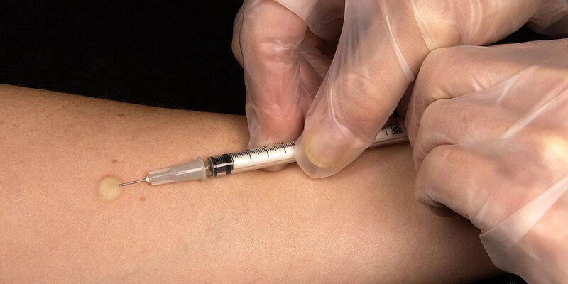 Tuberculosis (TB) Screening